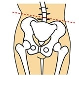 骨盤のズレ